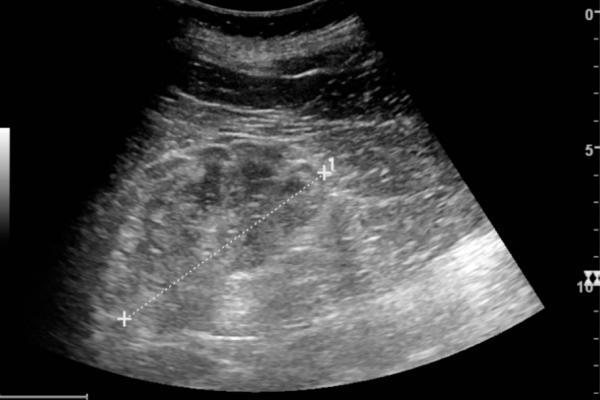 Ultrasonography of chronic renal disease caused by glomerulonephritis