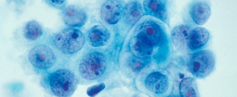 Breast cancer cells 768x315